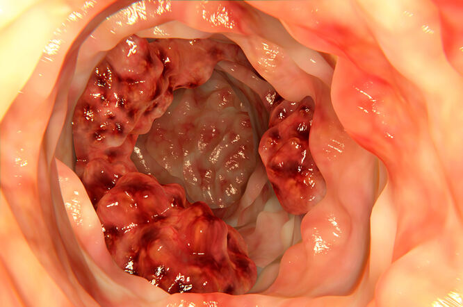Rak debelog crijeva - osnovne karakteristike bolesti