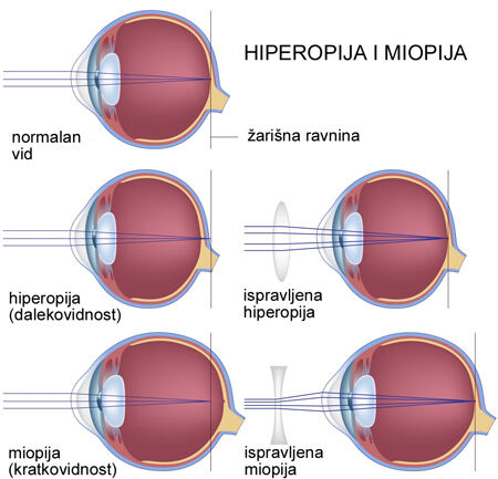 hiperopija-i-miopija-1b