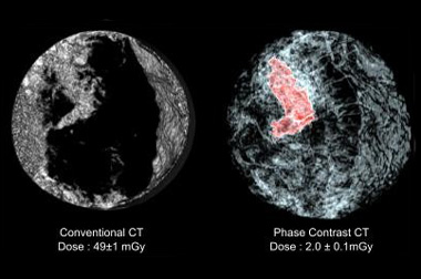 3-D mamogrami uspješniji u otkrivanju raka dojke od konvencionalnih mamograma