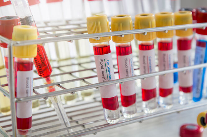 Pomoću testa krvi mogla bi se dijagnosticirati rana multipla skleroza