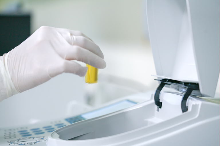 Više razine mikroplastike u urinu povezane s rizikom od endometrioze